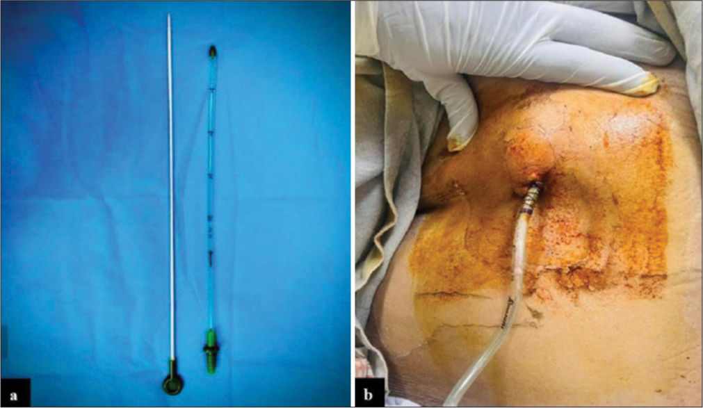 (a) Shows the Trocar catheter with pointed tip encircled and (b) shows the patient having a 24 G trocar catheter in situ.